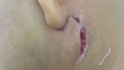 Three kids in Nghe An infected with Whitmore’s disease
