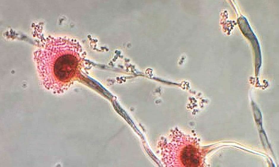 Nearly 15,000 Vietnamese suffer invasive pulmonary lung infection annually